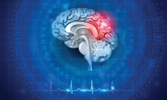 Ανεύρυσμα εγκεφάλου: Η κατάσταση που αυξάνει κατά 24% τον κίνδυνο